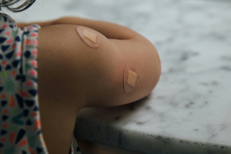 A child's upper arm with two circular bands.